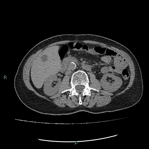 File:Aortic dissection extended to lusory artery (Radiopaedia 43686-47136 Axial non-contrast 36).jpg