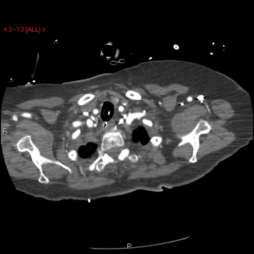 Aortic intramural hematoma (Radiopaedia 27746-28001 A 13).jpg
