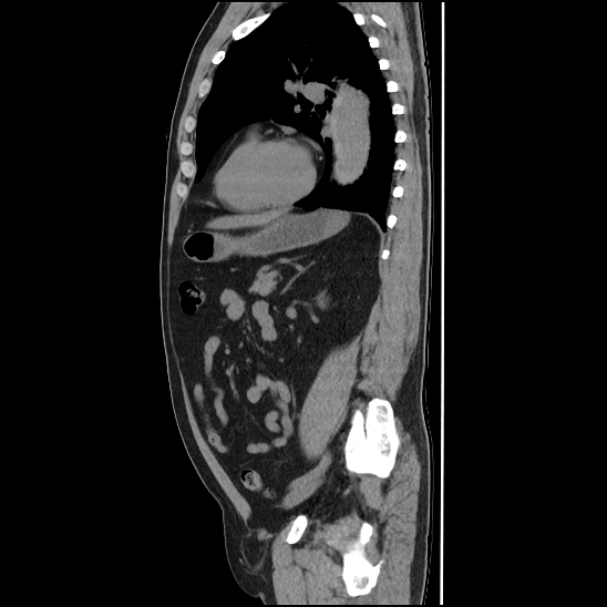 Aortic intramural hematoma (type B) (Radiopaedia 79323-92387 G 35).jpg