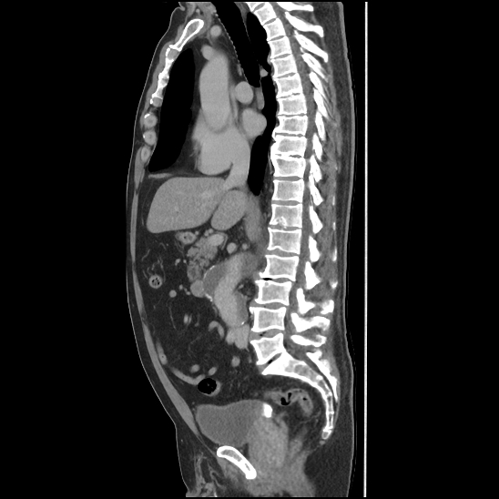 Aortic intramural hematoma (type B) (Radiopaedia 79323-92387 Sagittal C+ delayed 23).jpg