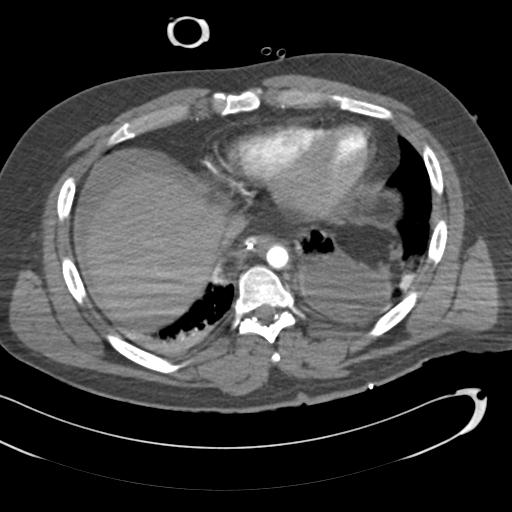 Aortic transection, diaphragmatic rupture and hemoperitoneum in a complex multitrauma patient (Radiopaedia 31701-32622 A 63).jpg