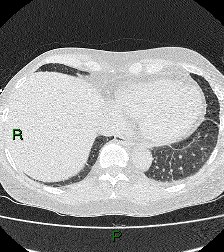 File:Aortic valve endocarditis (Radiopaedia 87209-103485 Axial lung window 79).jpg