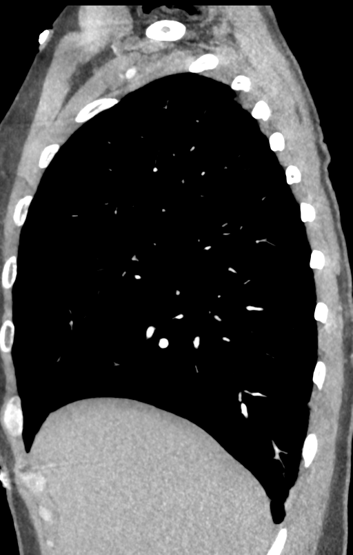 Aortic valve non-coronary cusp thrombus (Radiopaedia 55661-62189 C+ arterial phase 56).png