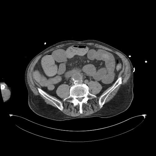 Aortoduodenal fistula (Radiopaedia 75286-86415 Axial non-contrast 44).jpg