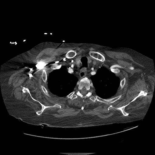 Aortoesophageal fistula with endovascular repair (Radiopaedia 73781-84592 Axial C+ CTPA 5).jpg