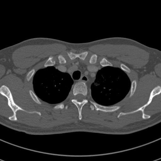 File:Apical lung mass mimic - neurogenic tumor (Radiopaedia 59918-67521 Axial bone window 14).jpg