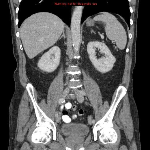 File:Appendicitis mass in inguinal hernia (Radiopaedia 26858-27029 B 44).jpg