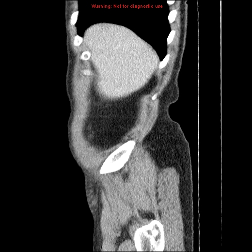 File:Appendicitis mass in inguinal hernia (Radiopaedia 26858-27029 C 2).jpg