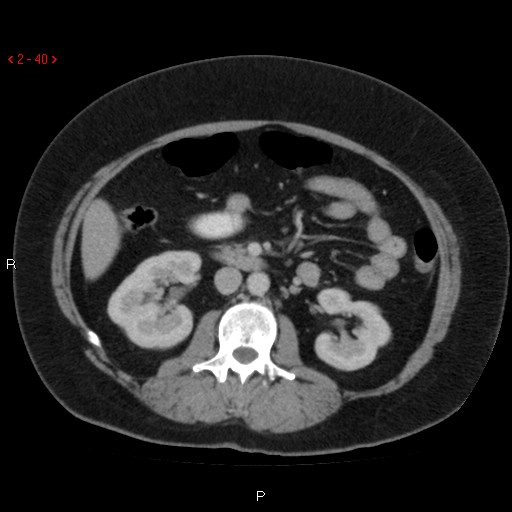 Appendicitis with microperforation- promontoric type (Radiopaedia 27268-27442 C 28).jpg