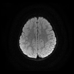 Arachnoid cyst - middle cranial fossa (Radiopaedia 86780-102938 Axial DWI 9).jpg