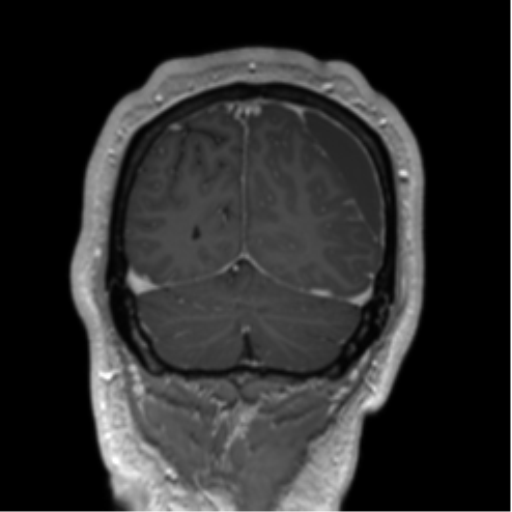 Arachnoid cyst with subdural hematoma (Radiopaedia 85892-101743 Coronal T1 C+ 15).png