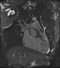 Arrhythmogenic right ventricular cardiomyopathy (Radiopaedia 57972-64966 CINE R2 SSFP 19).jpg
