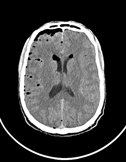 Arrow injury to the brain (Radiopaedia 72101-82607 Axial non-contrast 75).jpg