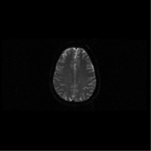 File:Arteriovenous malformation (cerebral) (Radiopaedia 40070-42580 Axial DWI 38).png