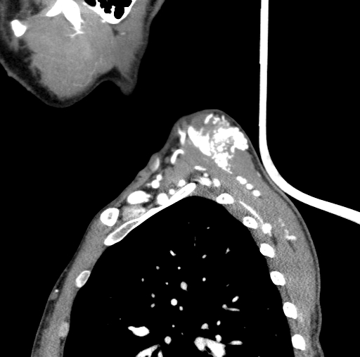 Arteriovenous malformation of the neck (Radiopaedia 53935-60062 C 14).jpg
