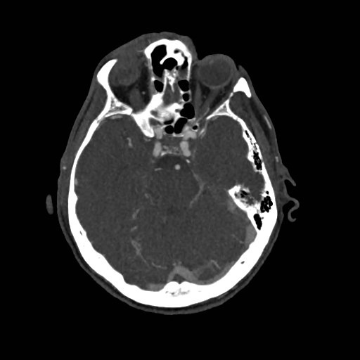 File:Artery of Percheron infarct (Radiopaedia 48088-52894 A 124).jpg