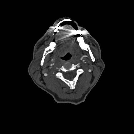 Artery of Percheron infarct (Radiopaedia 48088-52894 A 83).jpg