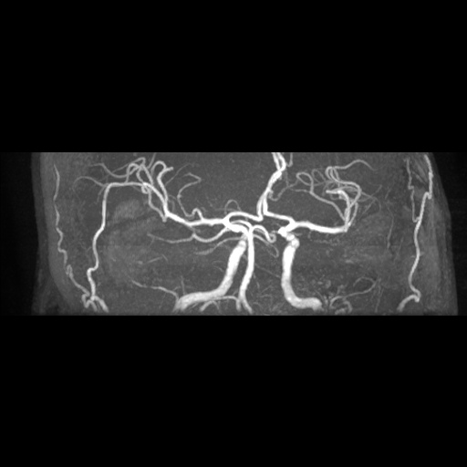 Artery of Percheron infarction (Radiopaedia 27975-28230 3D TOF 13).jpg