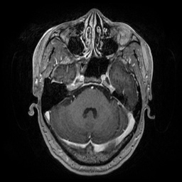 Artery of Percheron infarction (Radiopaedia 27975-28230 Axial T1 C+ fat sat 27).jpg