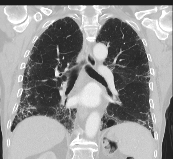 Asbestosis (Radiopaedia 56192-62864 Coronal lung window 32).png
