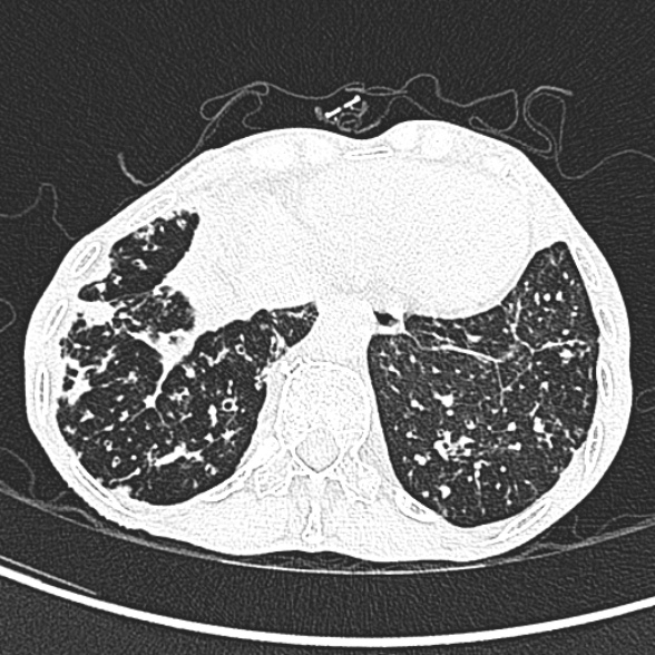 File:Aspergilloma- with Monod sign (Radiopaedia 44737-48532 Axial lung window 244).jpg