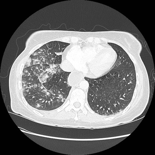 Aspiration pneumonia secondary to laparoscopic banding (Radiopaedia 18345-18183 lung window 84).jpg