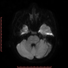Astroblastoma (Radiopaedia 74287-85162 Axial DWI 25).jpg