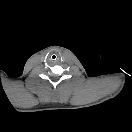 File:Atlanto-occipital dissociation (Traynelis type 1), C2 teardrop fracture, C6-7 facet joint dislocation (Radiopaedia 87655-104061 Axial non-contrast 64).jpg