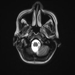 File:Atretic encephalocoele with inferior vermis hypoplasia (Radiopaedia 30443-31108 Axial T2 2).jpg