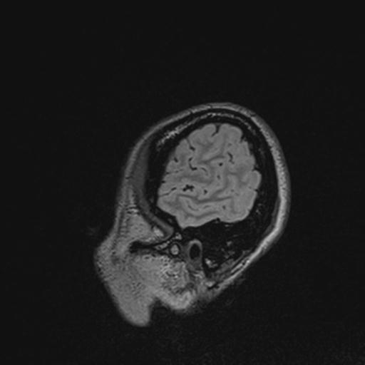 Atretic encephalocoele with inferior vermis hypoplasia (Radiopaedia 30443-31108 Sagittal FLAIR 137).jpg