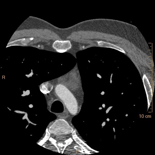 Atrial septal defect (upper sinus venosus type) with partial anomalous pulmonary venous return into superior vena cava (Radiopaedia 73228-83961 A 4).jpg