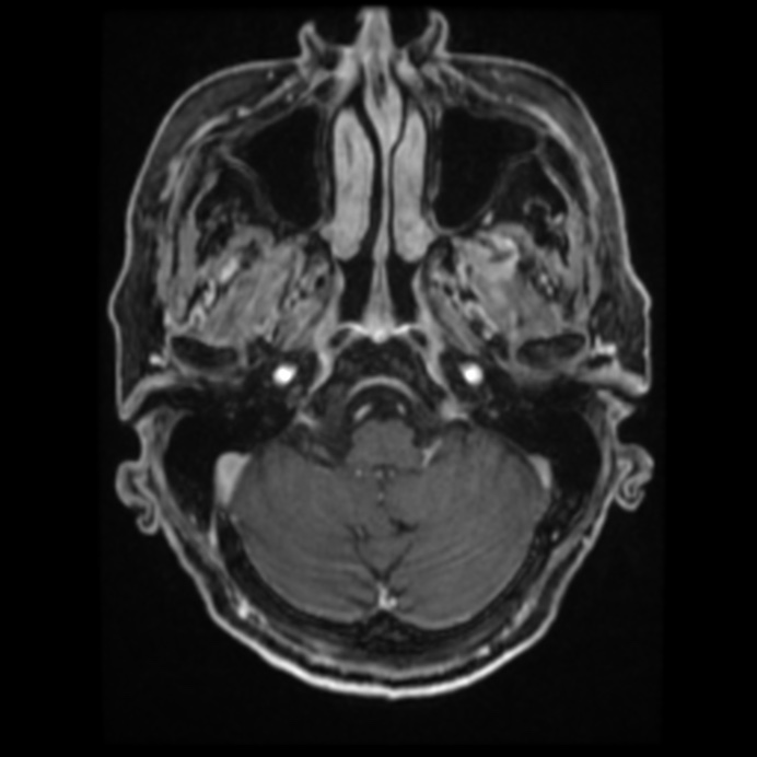 Atypical meningioma (Radiopaedia 45535-49629 Axial T1 C+ 21).jpg