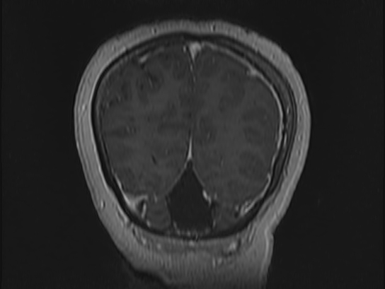 Atypical meningioma (Radiopaedia 62985-71406 Coronal T1 C+ 110).jpg