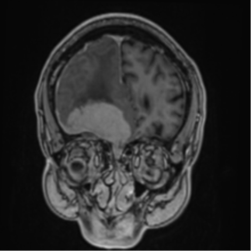 Atypical meningioma (WHO grade II) with brain invasion (Radiopaedia 57767-64729 Coronal T1 C+ 16).png