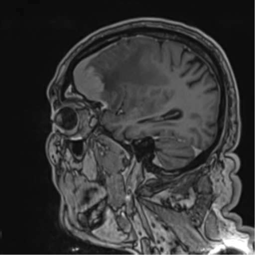 File:Atypical meningioma (WHO grade II) with brain invasion (Radiopaedia 57767-64729 Sagittal T1 C+ 48).png
