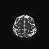 File:Autoimmune limbic encephalitis (Radiopaedia 30363-31005 Axial B0 and DWI 27).jpg