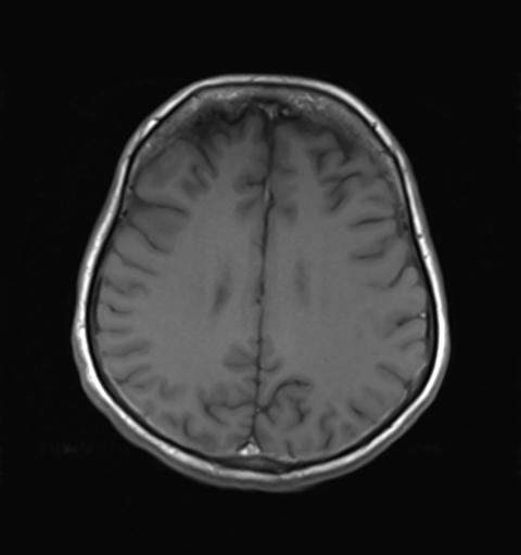 File:Autoimmune limbic encephalitis (Radiopaedia 30363-31005 Axial T1 22).jpg