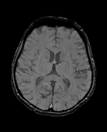 Autoimmune limbic encephalitis (Radiopaedia 30363-31005 SWI - magnitude 44).jpg