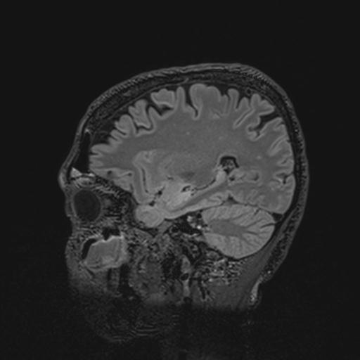 Autoimmune limbic encephalitis (Radiopaedia 30363-31005 Sagittal FLAIR 106).jpg