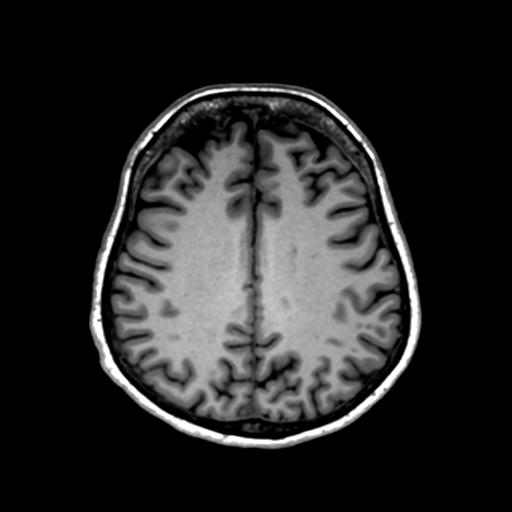 Autoimmune limbic encephalitis (Radiopaedia 30363-31005 T1 Axial 1mm 103).jpg