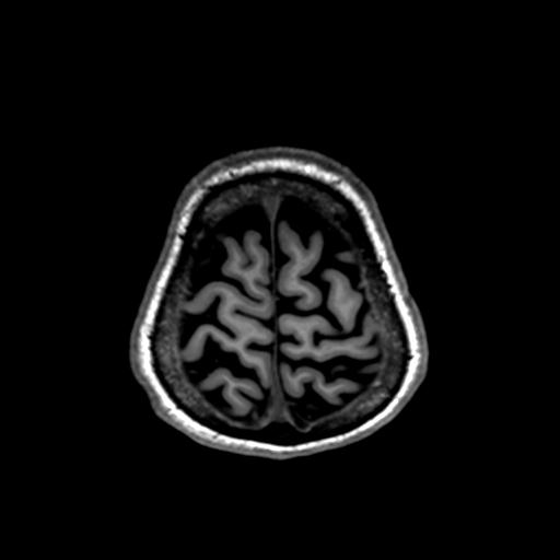 Autoimmune limbic encephalitis (Radiopaedia 30363-31005 T1 Axial 1mm 134).jpg