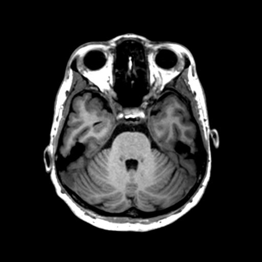 Autoimmune limbic encephalitis (Radiopaedia 30363-31005 T1 Axial 1mm 50).jpg