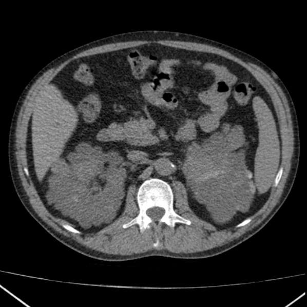 File:Autosomal dominant polycystic kidney disease (Radiopaedia 36539-38101 Axial non-contrast 32).jpg
