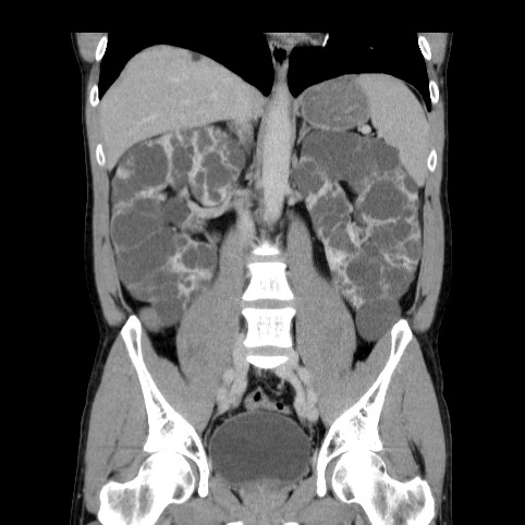 Autosomal dominant polycystic kidney disease (Radiopaedia 66349-75582 A 48).jpg