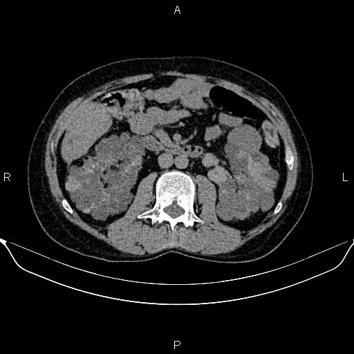Autosomal dominant polycystic kidney disease (Radiopaedia 87830-104287 Axial non-contrast 26).jpg