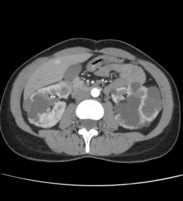 Autosomal dominant polycystic kidney disease - early onset (Radiopaedia 40734-43387 B 32).jpg