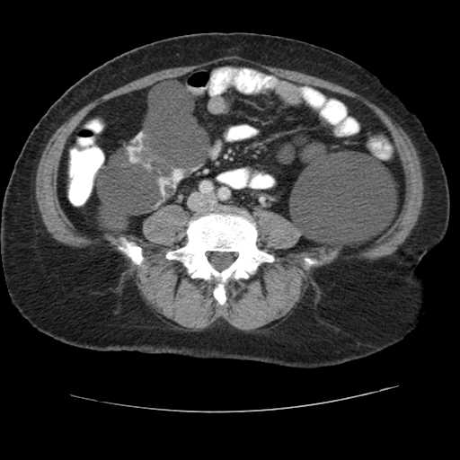 Autosomal dominant polycystic kidney disease with hepatic involvement (Radiopaedia 32693-33662 B 52).jpg