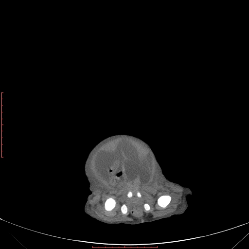 File:Autosomal recessive polycystic kidney disease associated with Caroli disease (Radiopaedia 61932-69984 Axial non-contrast 349).jpg