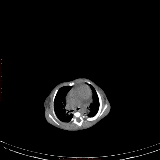 Autosomal recessive polycystic kidney disease associated with Caroli disease (Radiopaedia 61932-69984 Axial non-contrast 48).jpg