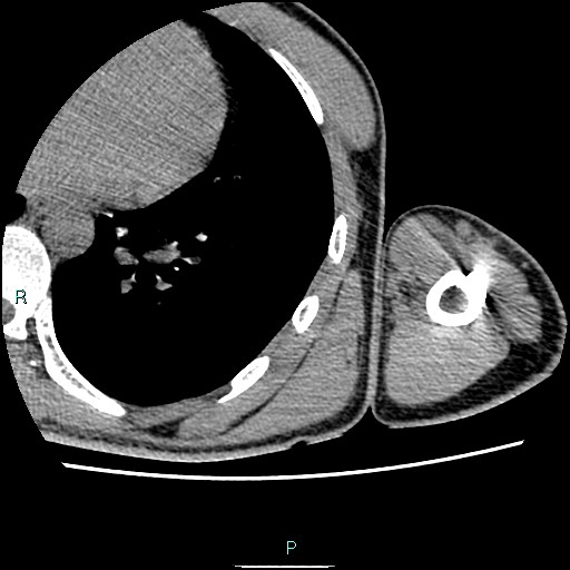 File:Avascular necrosis after fracture dislocations of the proximal humerus (Radiopaedia 88078-104653 D 90).jpg